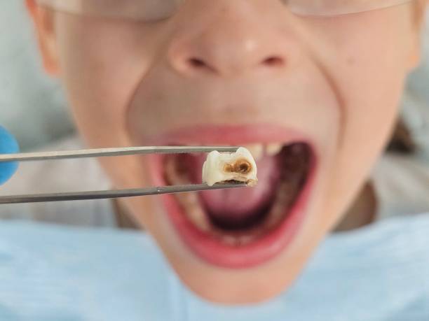 Best Broken or Cracked Tooth Emergency Dentist in Olive Hill, KY
